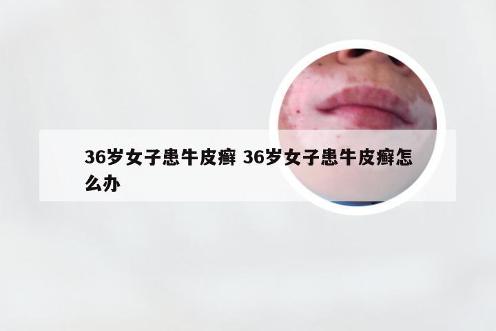 36岁女子患牛皮癣 36岁女子患牛皮癣怎么办