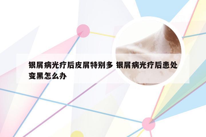 银屑病光疗后皮屑特别多 银屑病光疗后患处变黑怎么办