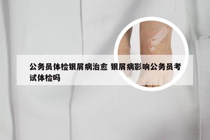 公务员体检银屑病治愈 银屑病影响公务员考试体检吗