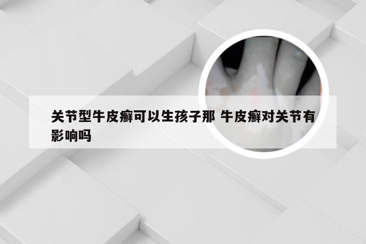 关节型牛皮癣可以生孩子那 牛皮癣对关节有影响吗