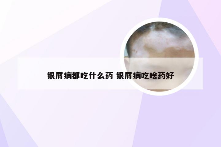 银屑病都吃什么药 银屑病吃啥药好