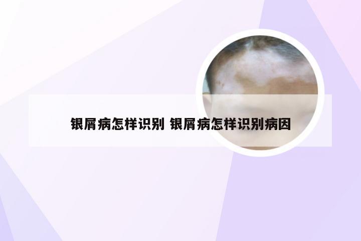 银屑病怎样识别 银屑病怎样识别病因