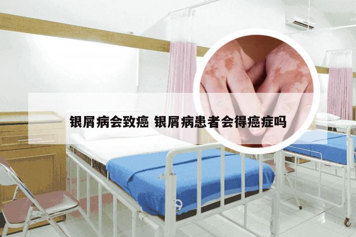 银屑病会致癌 银屑病患者会得癌症吗