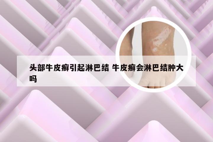 头部牛皮癣引起淋巴结 牛皮癣会淋巴结肿大吗