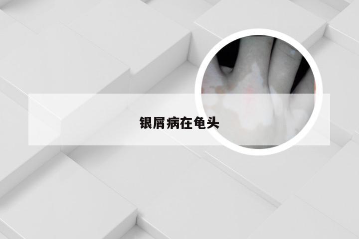 银屑病在龟头