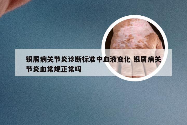 银屑病关节炎诊断标准中血液变化 银屑病关节炎血常规正常吗