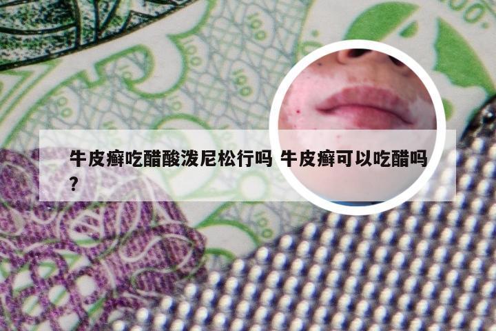 牛皮癣吃醋酸泼尼松行吗 牛皮癣可以吃醋吗?