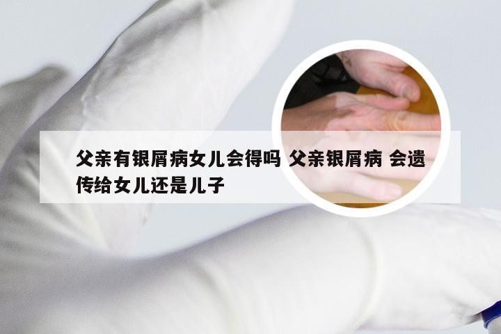 父亲有银屑病女儿会得吗 父亲银屑病 会遗传给女儿还是儿子