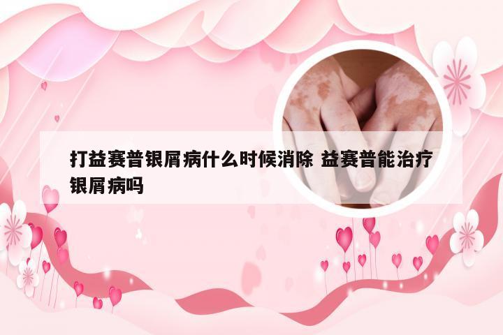 打益赛普银屑病什么时候消除 益赛普能治疗银屑病吗