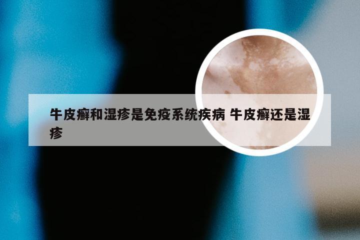 牛皮癣和湿疹是免疫系统疾病 牛皮癣还是湿疹