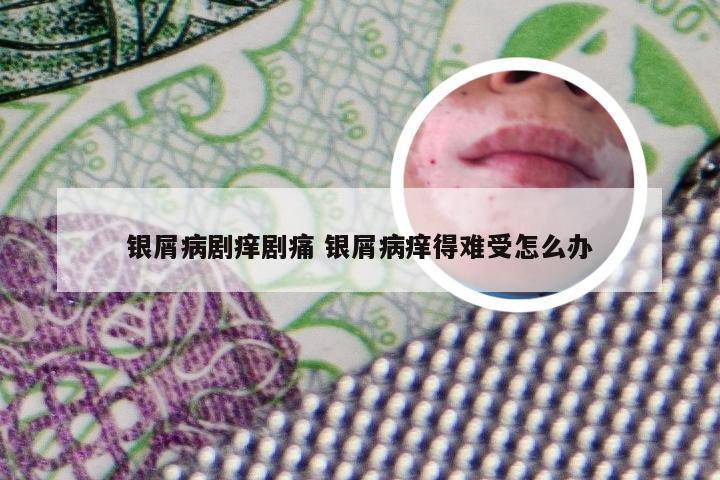 银屑病剧痒剧痛 银屑病痒得难受怎么办
