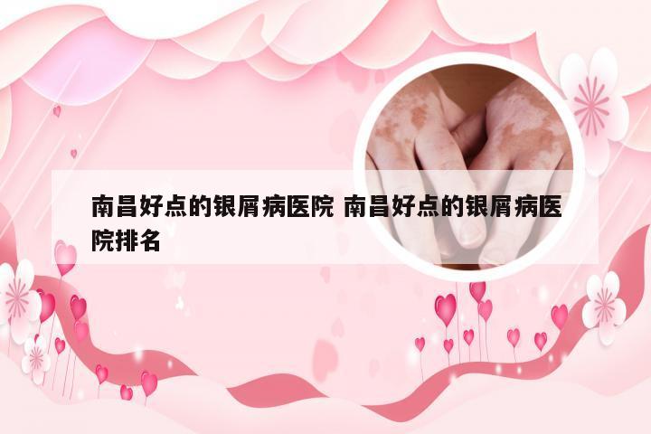 南昌好点的银屑病医院 南昌好点的银屑病医院排名