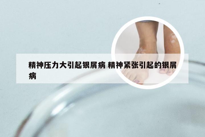 精神压力大引起银屑病 精神紧张引起的银屑病