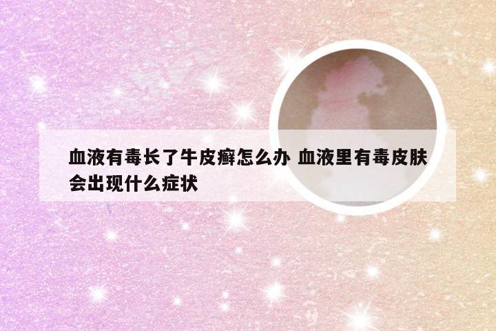 血液有毒长了牛皮癣怎么办 血液里有毒皮肤会出现什么症状