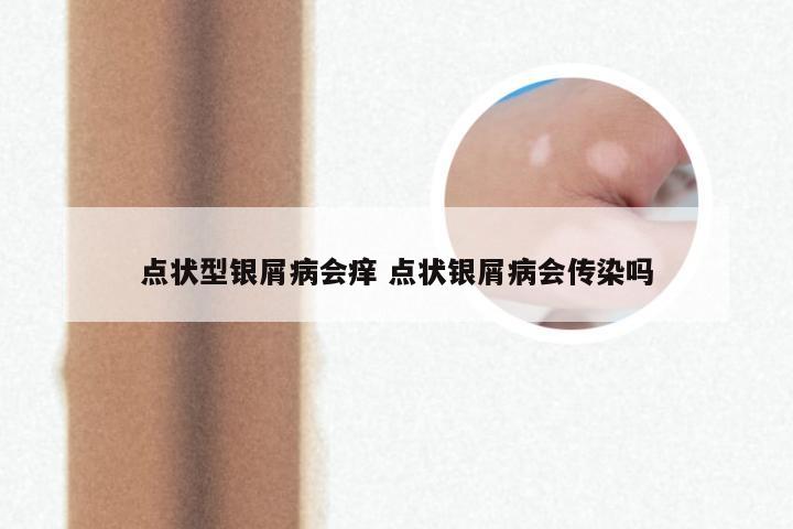 点状型银屑病会痒 点状银屑病会传染吗