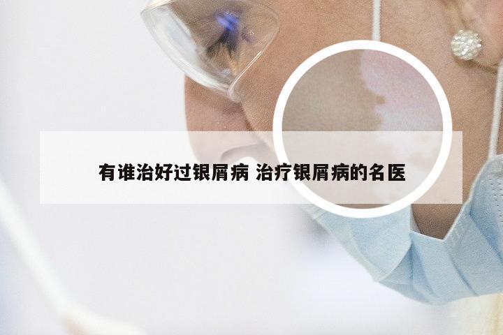有谁治好过银屑病 治疗银屑病的名医