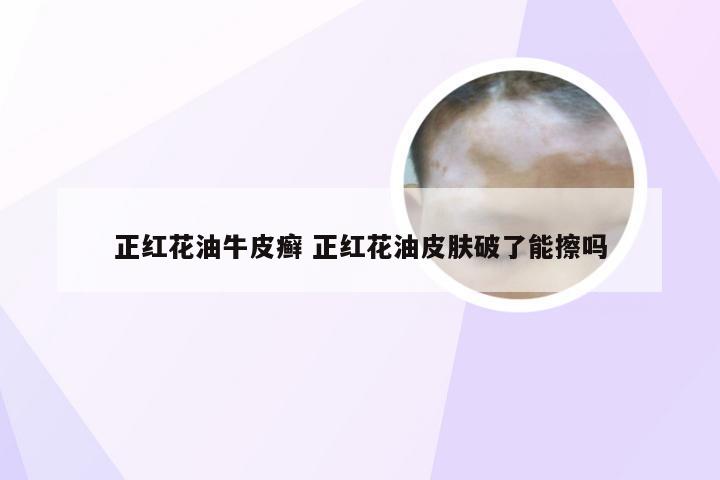 正红花油牛皮癣 正红花油皮肤破了能擦吗