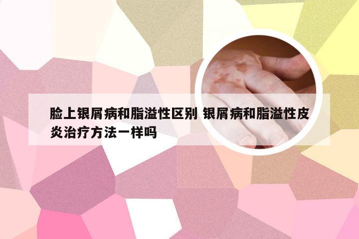 脸上银屑病和脂溢性区别 银屑病和脂溢性皮炎治疗方法一样吗