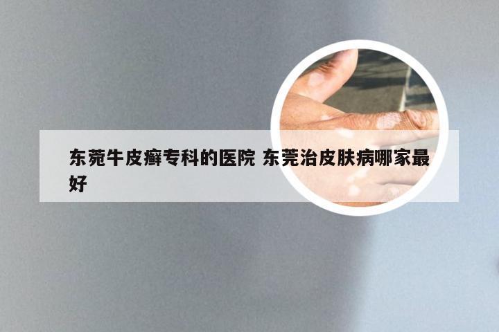 东菀牛皮癣专科的医院 东莞治皮肤病哪家最好