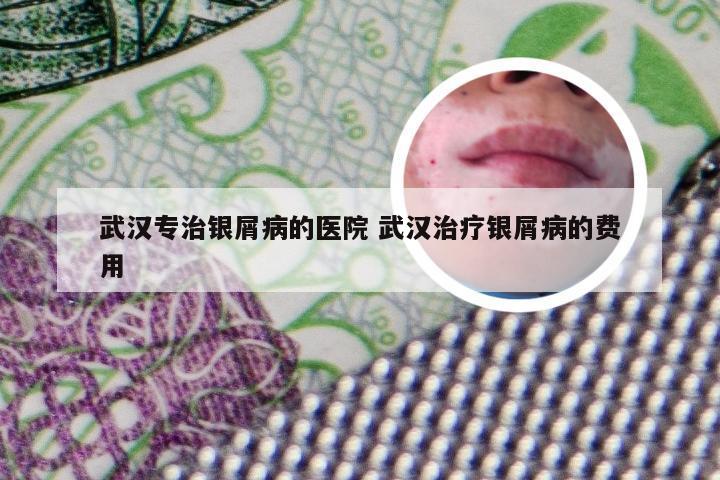 武汉专治银屑病的医院 武汉治疗银屑病的费用