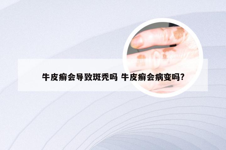 牛皮癣会导致斑秃吗 牛皮癣会病变吗?