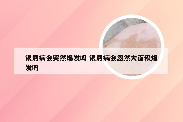 银屑病会突然爆发吗 银屑病会忽然大面积爆发吗