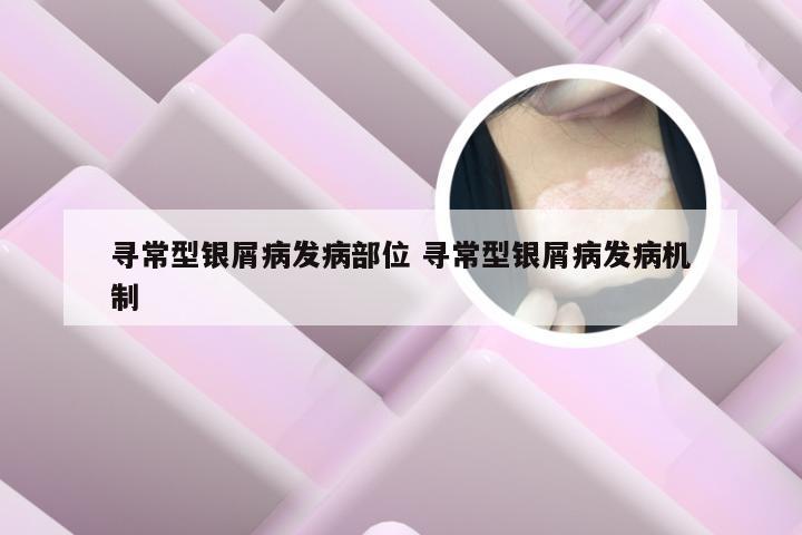 寻常型银屑病发病部位 寻常型银屑病发病机制