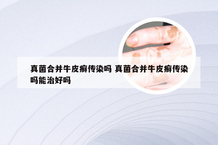 真菌合并牛皮癣传染吗 真菌合并牛皮癣传染吗能治好吗