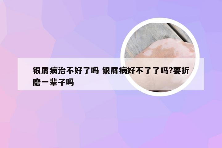 银屑病治不好了吗 银屑病好不了了吗?要折磨一辈子吗