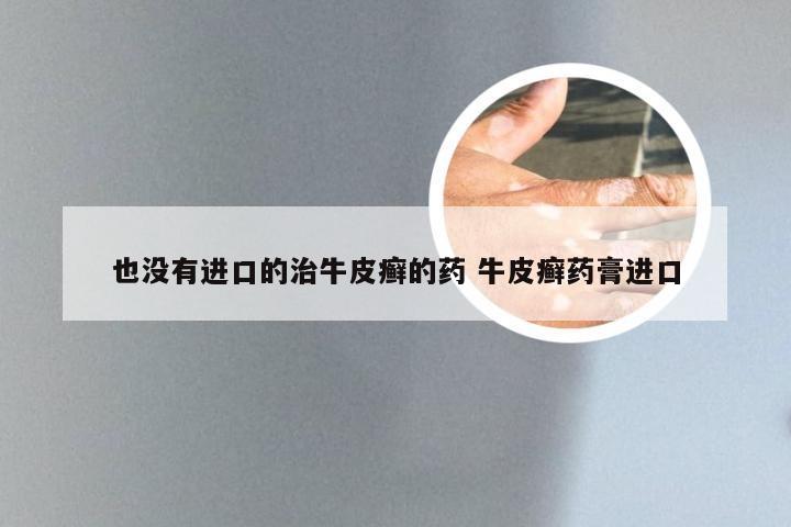 也没有进口的治牛皮癣的药 牛皮癣药膏进口