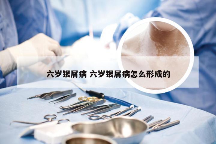 六岁银屑病 六岁银屑病怎么形成的