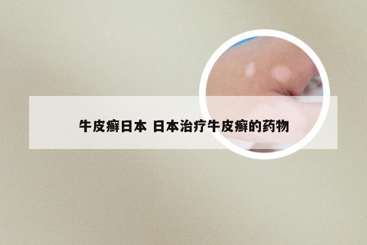 牛皮癣日本 日本治疗牛皮癣的药物