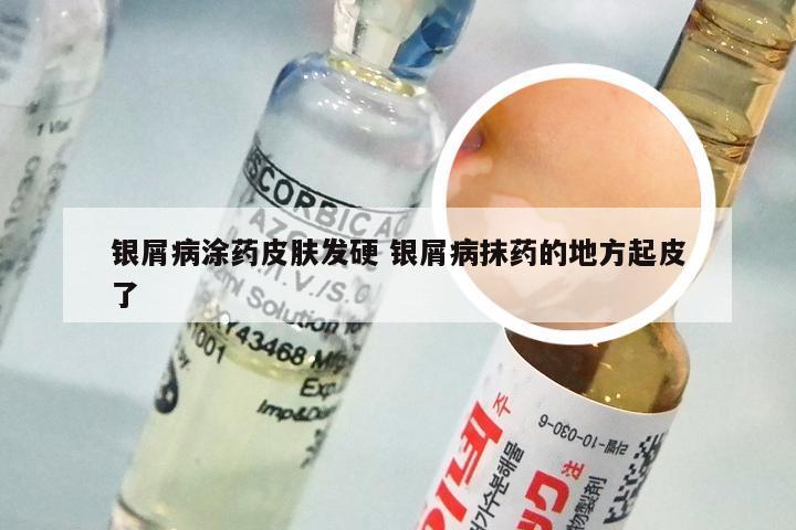 银屑病涂药皮肤发硬 银屑病抹药的地方起皮了