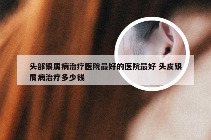 头部银屑病治疗医院最好的医院最好 头皮银屑病治疗多少钱
