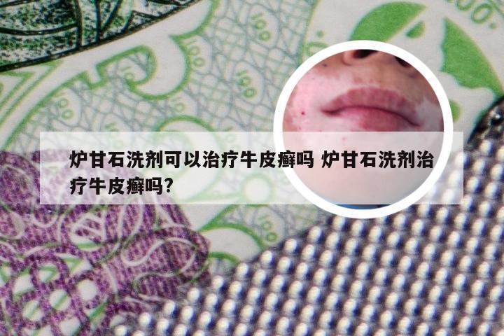 炉甘石洗剂可以治疗牛皮癣吗 炉甘石洗剂治疗牛皮癣吗?