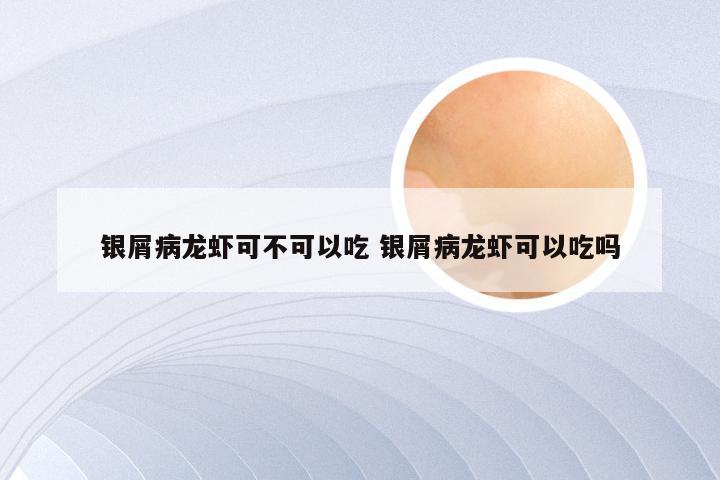 银屑病龙虾可不可以吃 银屑病龙虾可以吃吗