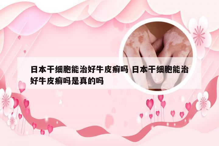 日本干细胞能治好牛皮癣吗 日本干细胞能治好牛皮癣吗是真的吗