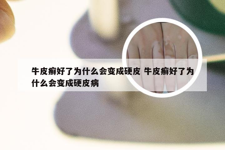 牛皮癣好了为什么会变成硬皮 牛皮癣好了为什么会变成硬皮病