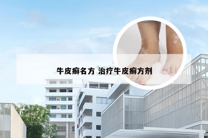 牛皮癣名方 治疗牛皮癣方剂