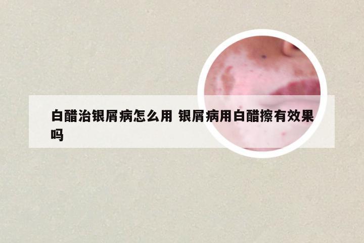 白醋治银屑病怎么用 银屑病用白醋擦有效果吗