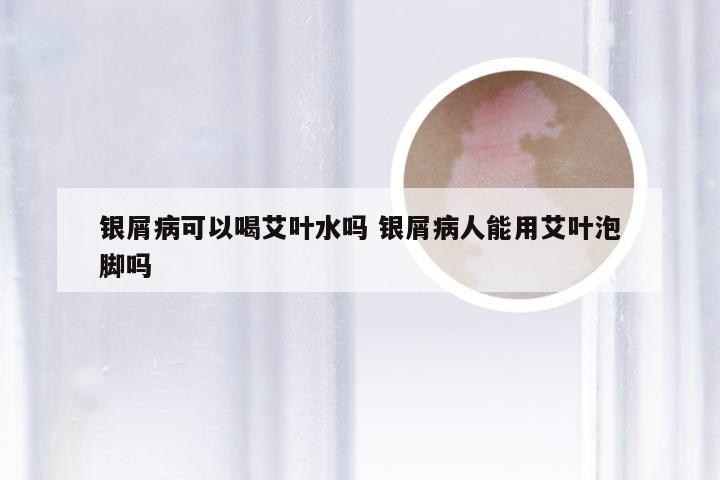 银屑病可以喝艾叶水吗 银屑病人能用艾叶泡脚吗