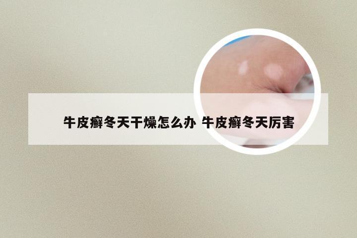 牛皮癣冬天干燥怎么办 牛皮癣冬天厉害