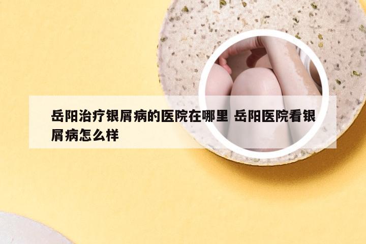 岳阳治疗银屑病的医院在哪里 岳阳医院看银屑病怎么样