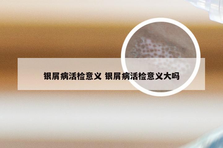 银屑病活检意义 银屑病活检意义大吗