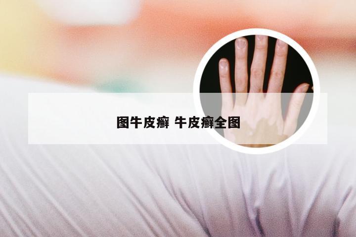 图牛皮癣 牛皮癣全图