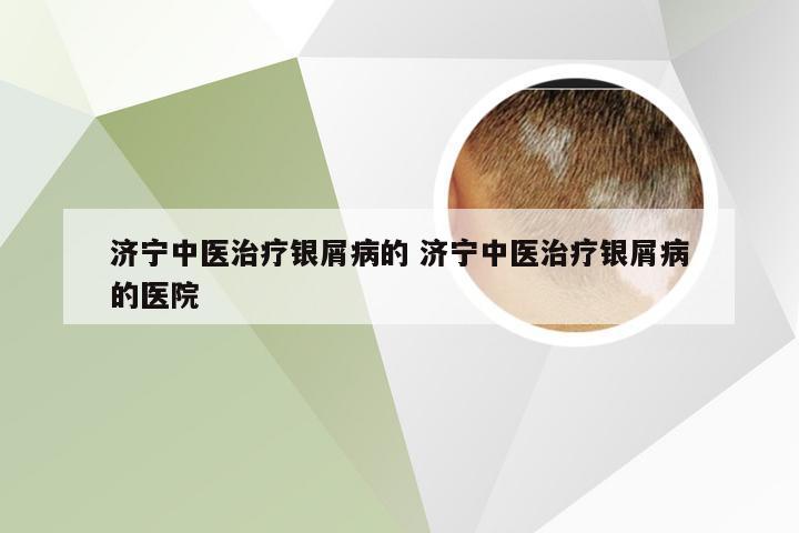 济宁中医治疗银屑病的 济宁中医治疗银屑病的医院