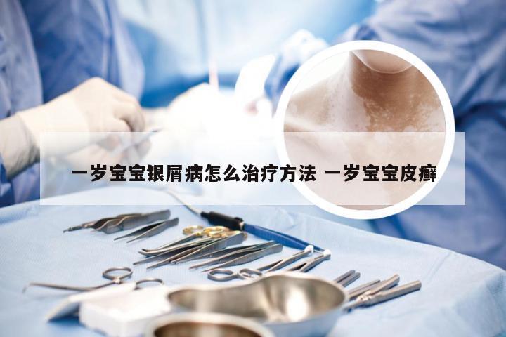 一岁宝宝银屑病怎么治疗方法 一岁宝宝皮癣