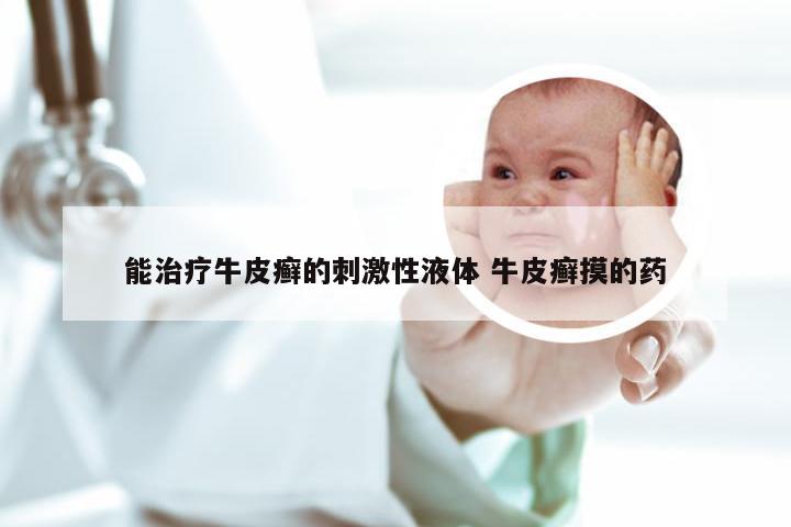 能治疗牛皮癣的刺激性液体 牛皮癣摸的药