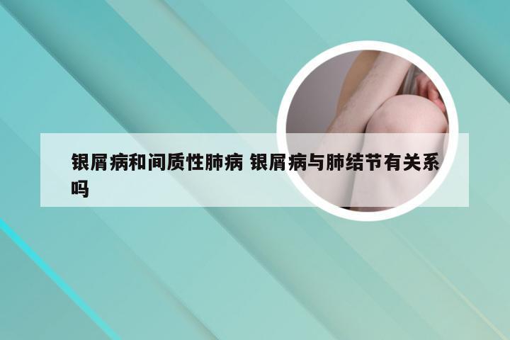 银屑病和间质性肺病 银屑病与肺结节有关系吗