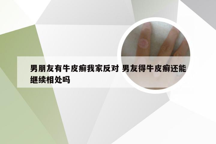 男朋友有牛皮癣我家反对 男友得牛皮癣还能继续相处吗